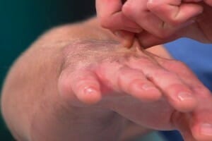 Skin pinch test for dehydration Lifesong Wilderness Adventures